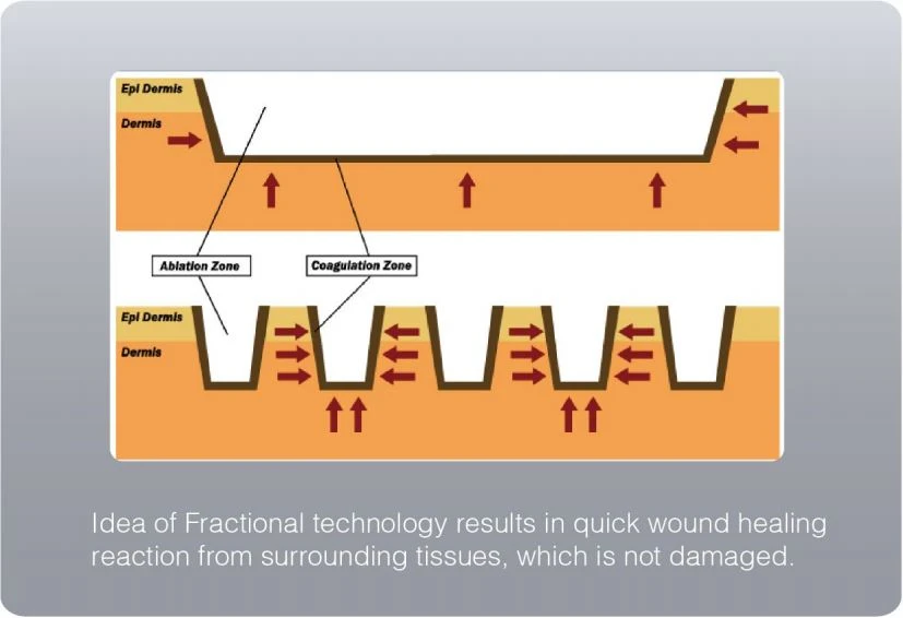 Pinxel-2 Fractional Microneedle RF Machine